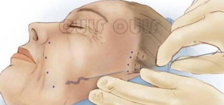 分析专业分析:蛋白线埋线一根多少钱?胶原蛋白线这个价格贵不!靠谱吗