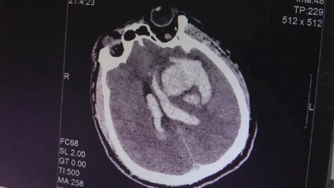 脑血管|与家人失联十多个小时后，男子被发现晕倒在出租屋里，意外发生的原因是……