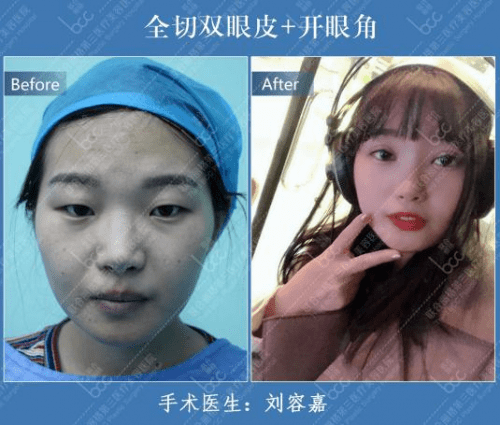 眼睛天津联合丽格刘容嘉主任《嘉话整形》双眼皮常见的5大误区及解答