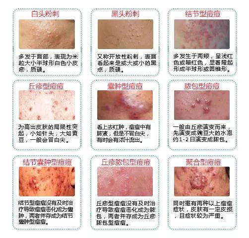 青春痘灿加老师小课堂：先祛痘还是先祛痘印？10个女生9个会弄错！顺序不对秒毁容！