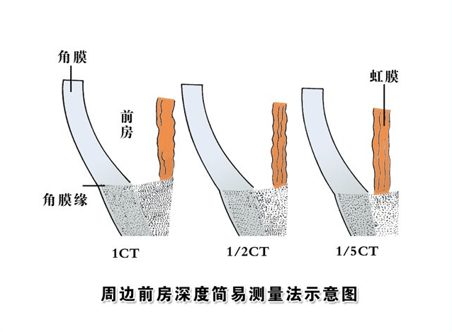 高度近视,前房深度小于28mm,还能做晶体植入手术吗?