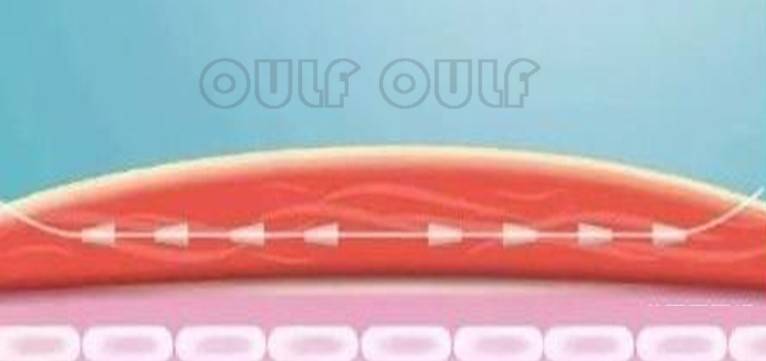 蛋白线雕面部出现凹陷可以补救吗？面部线雕做过的来说说！