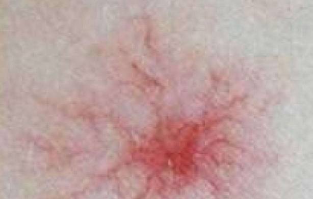 治疗|肝硬化发现要趁早,抓住早期3个症状,或许能助你阻止肝“变硬”