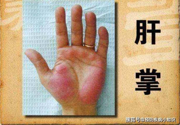 眼睛|肝是“哑巴”,身体若出现四种异常,说明肝脏在走下坡路,别大意