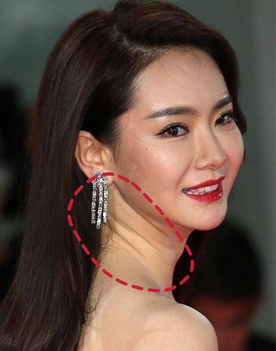 颈部明星都躲不掉的颈纹该怎么消除？