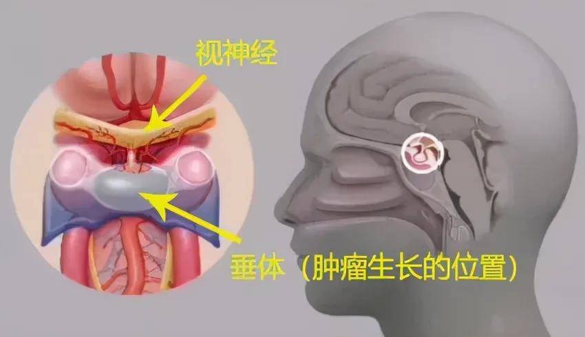 治疗|44岁加拿大华人万里求医，神外专家妙手除疾！