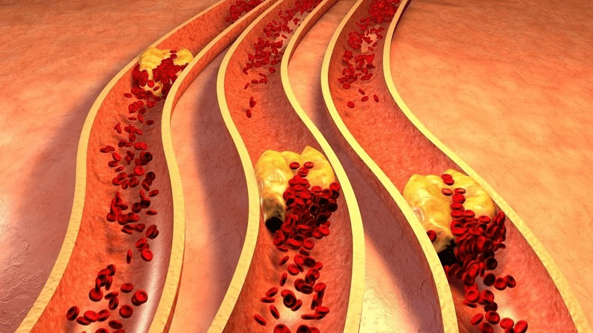 肠道|中老年人别冒险，饭后不做这3件事，可以减少脑梗风险