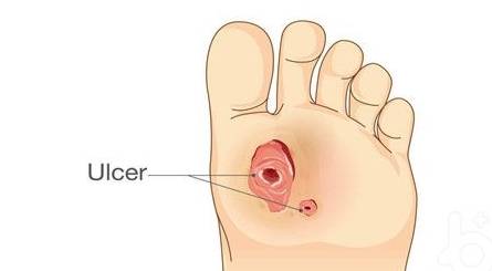 并发症|糖尿病并发症中,尤其这4种要提早预防!