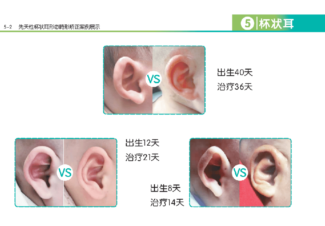 新生兒先天性耳廓畸形無創矯正