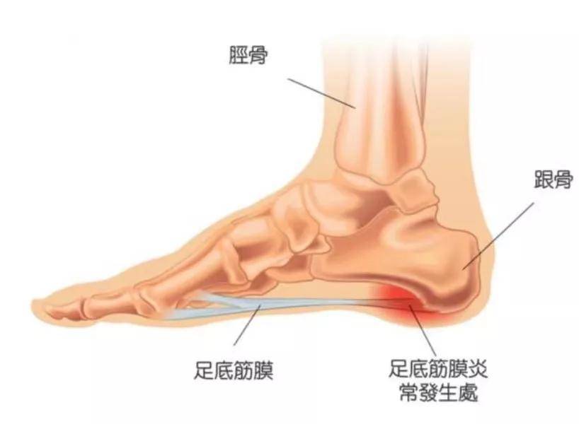 足跟疼 大概是足底筋膜炎盯上你了 腹针治疗足底筋膜炎病例分享 针灸