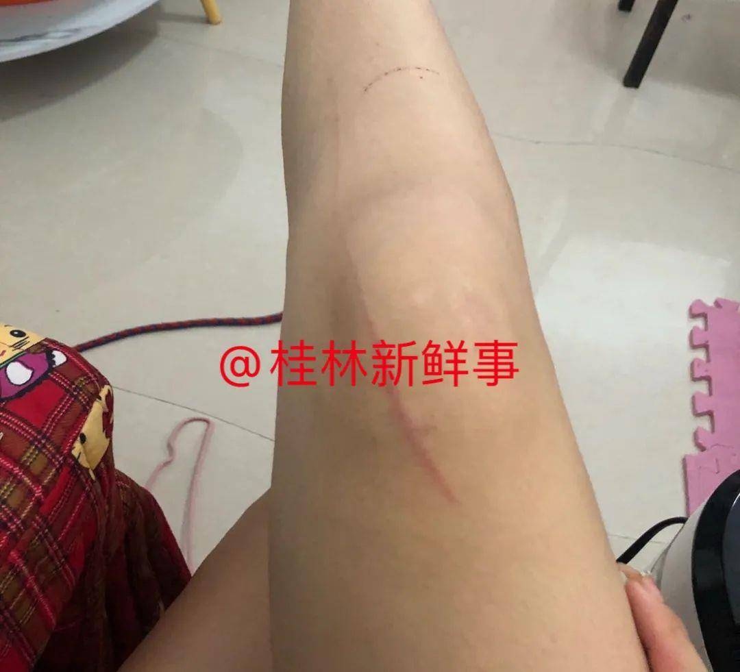 进行爆料！桂林某女子被没牵绳的狗咬了，狗主人竟然还对她人身威胁？