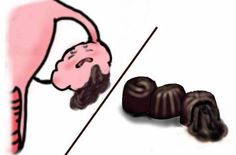 巧克力囊肿有什么症状 要不要手术 饮食禁忌有哪些 带你一次了解清楚 子宫