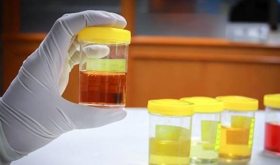 毒素|尿液发黄异味大?多半是在向你“报告”这4件事,希望你能放心上