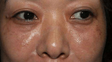 脸部刚做完线雕脸部有凹凸正常吗、内心慌的一批~