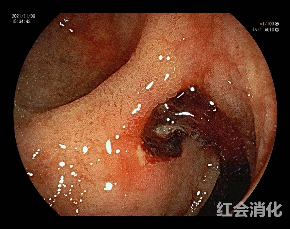 休克|小伙遇车祸消化道大出血休克 西安市红会医院紧急救治挽生命
