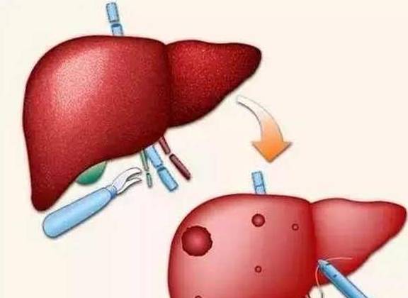 速胜论|与乙肝抗衡的“拉锯战”,想要获得完胜,必须深谙2个战略!