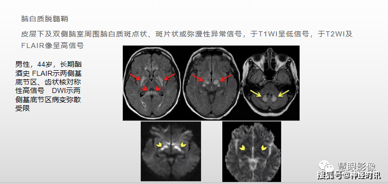 病例分享 | 慢性酒精中毒性脑病 来源: 神经时讯