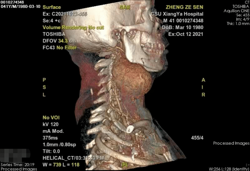 肿瘤|颈部包块竟是巨大颈动脉体瘤，湘雅专家“拆弹”助男子脱险境