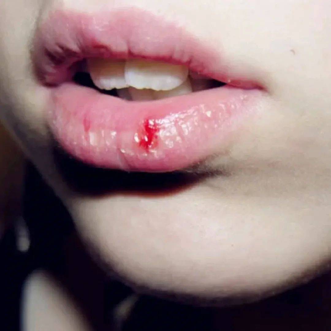 冬天嘴唇再干也别一直舔._水分