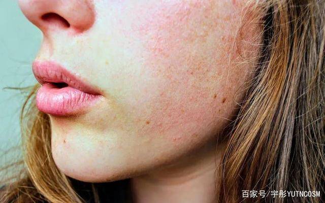 冬季干燥敏感肌,90%女生没做好这些皮肤管理!
