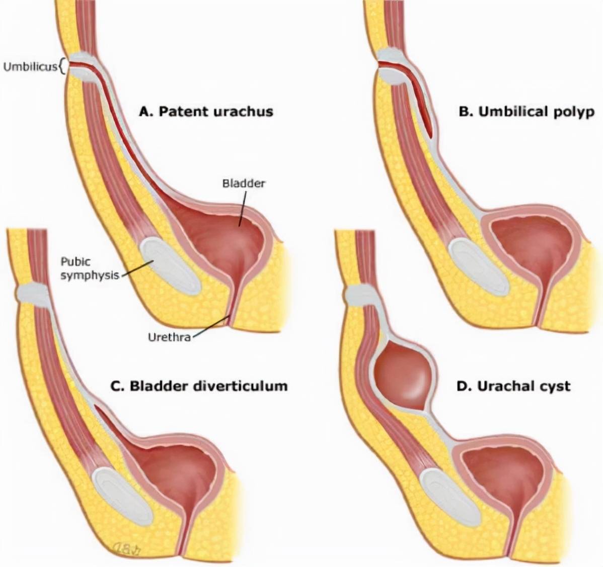 女性脐尿管囊肿手术图片