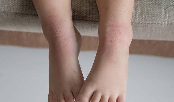 肾脏|“尿毒症”早期可能会有这几个“现象”，早知道早受益