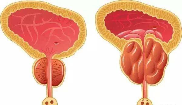 原创固精缩尿的中药能够治疗前列腺肥大中医更加讲究整体治疗的思路