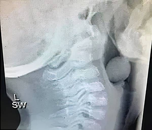 坚果|危险的「一分钟手术」差点要了2岁孩子的命，只因妈妈做这件小事