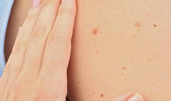 色素瘤的位置 9f85ef76f13942f19b5b70043244ae5c.jpeg