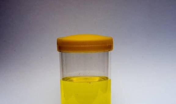 出现泡沫|血糖高，尿液也许有这3种“异常”，若你没中，祝贺血糖还算稳定