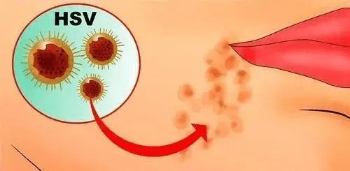 一文带你了解病毒中的三剑客hpv、hiv、hsv