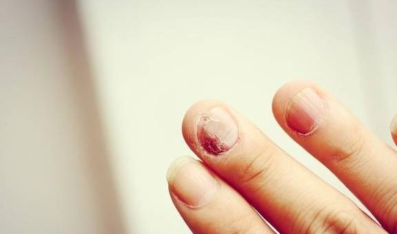 【灰指甲】灰指甲发病原因_灰指甲的预防与护理