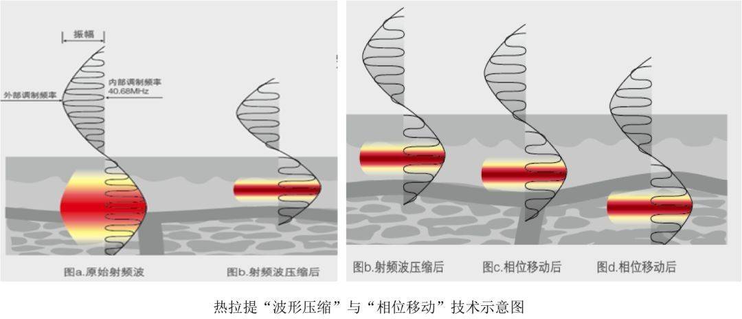 真皮大实话：热拉提多少钱做一次？热拉提多久做一次合适？