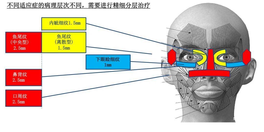 真皮大实话：热拉提多少钱做一次？热拉提多久做一次合适？