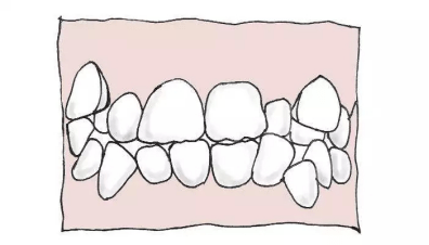 維樂·中澤口腔|成人牙齒排列不齊怎麼辦