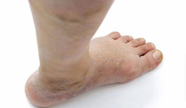 症状|尿酸高的人，若有这2种症状，可能已经连累到了肾脏，希望你没有