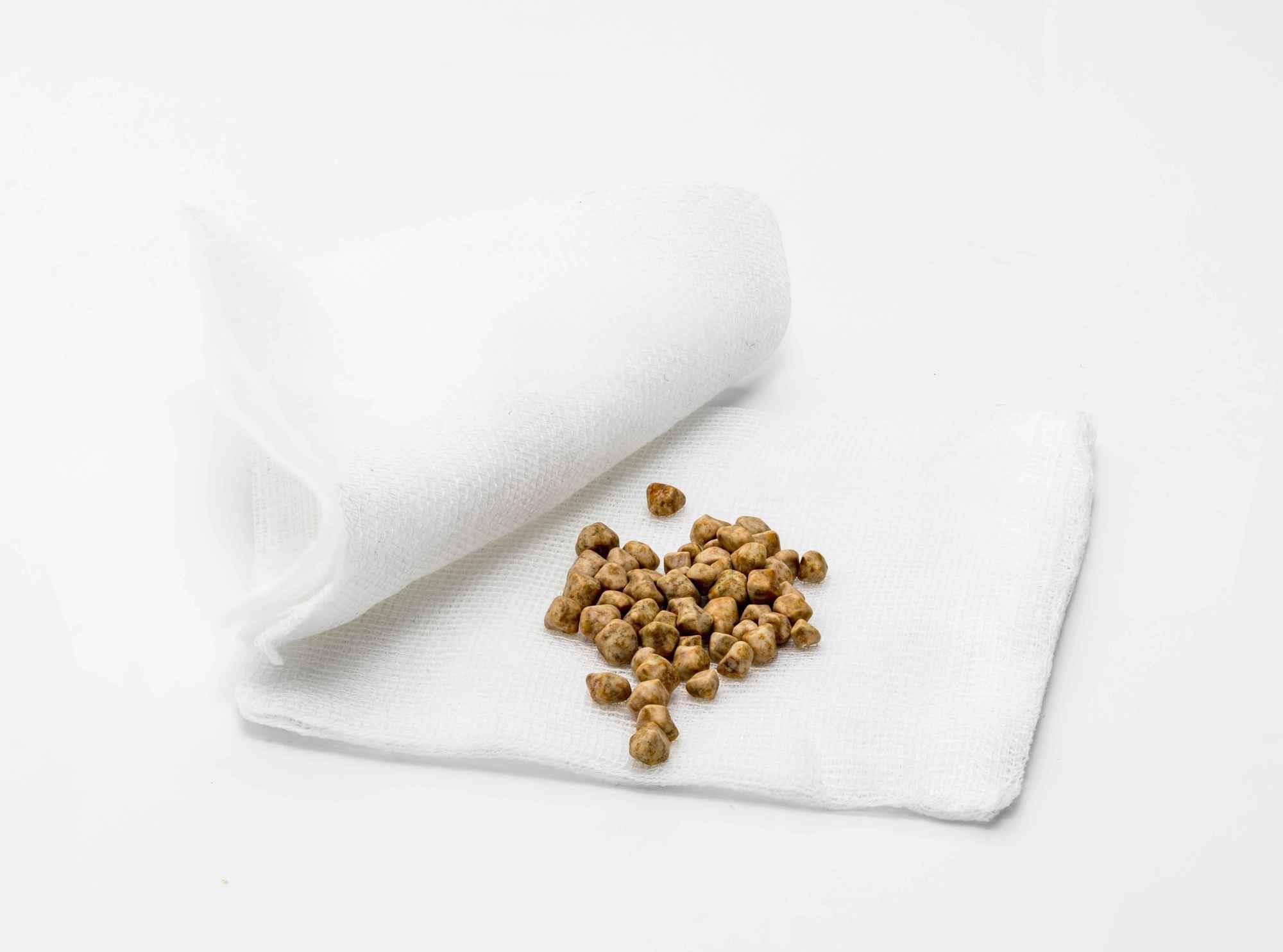 治疗|1258颗结石从体内取出，无症状？或是这3个症状，你而不自知