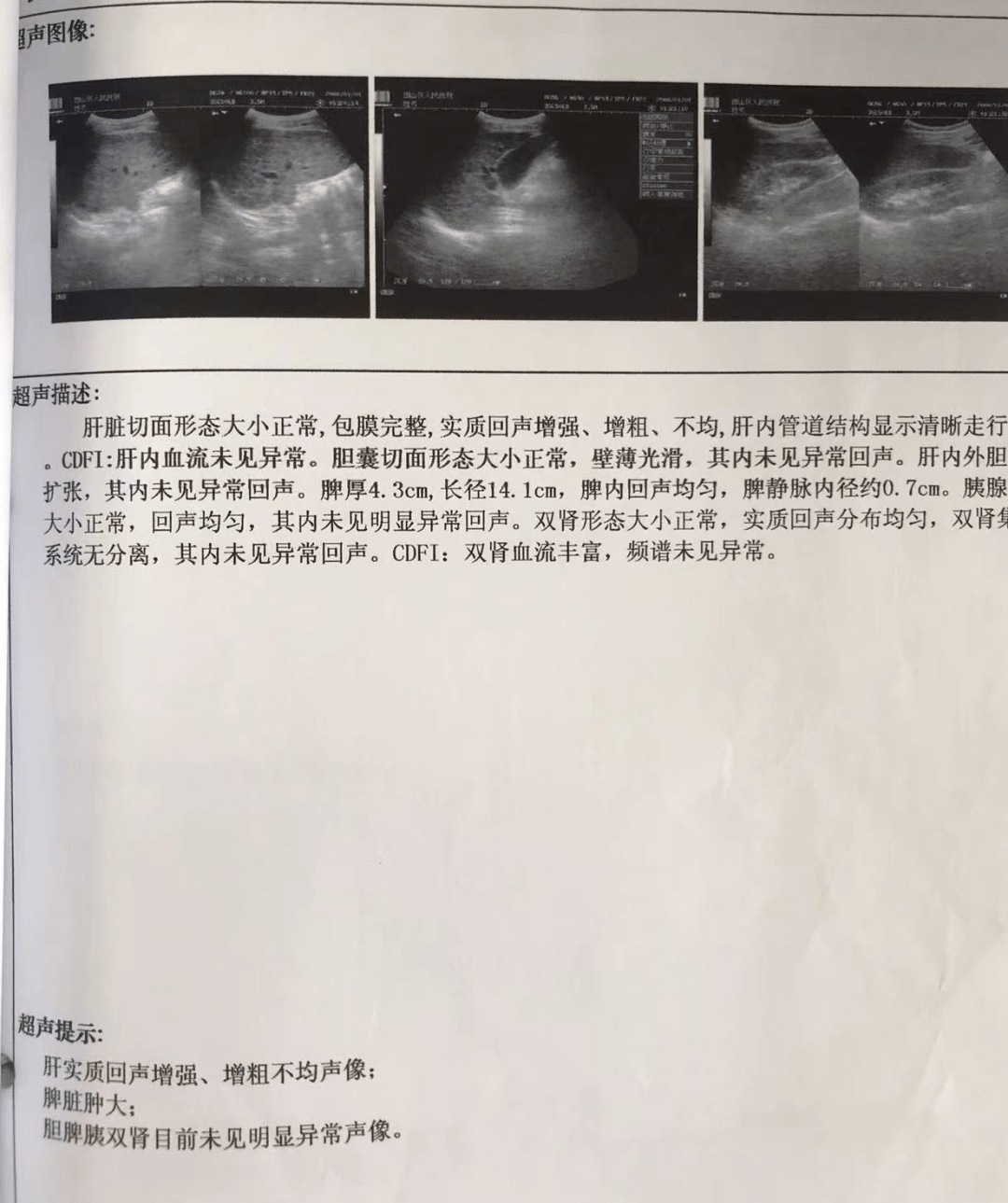 「病例分享」肝豆状核变性继发震颤:35岁男性患者,双手不自主抖动10年