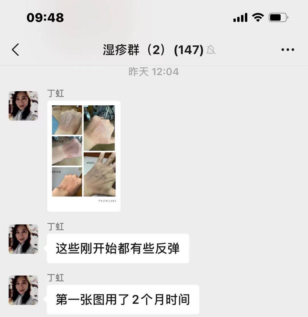 因为碧蒂曼诗3D仿生膏：用了四天美肤安湿疹膏，孩子脸上，眼周越来越严重