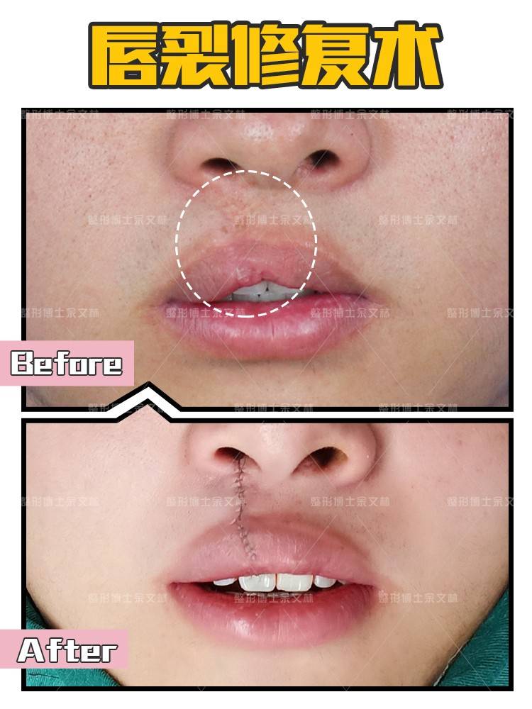 唇裂继发红唇畸形脂肪填充可以修复吗余文林在线科普