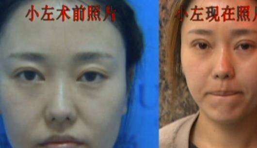 说法女子花6万整容后不满，找说法反遭医生嘲讽：你生过孩子没？