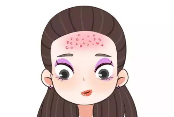 皮肤科医生告诉你额头常冒痘痘可以这么做