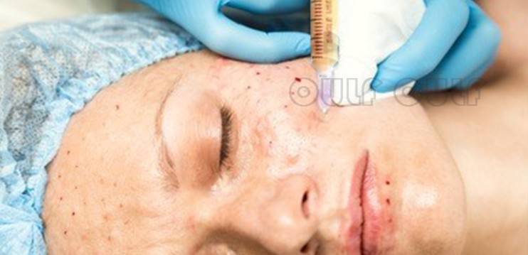 能量丑：脂肪填充2个月好难看？全脸脂肪填充后遗症让我好后悔~
