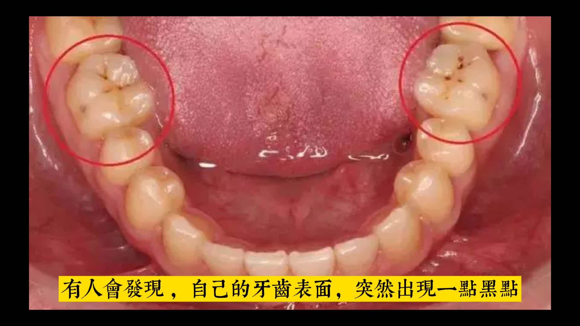 牙齒上小黑點的可怕力量齲齒