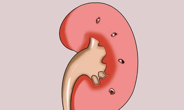步骤|从肾炎到尿毒症,大约要经历几个步骤?不想留遗憾,注意3个信号