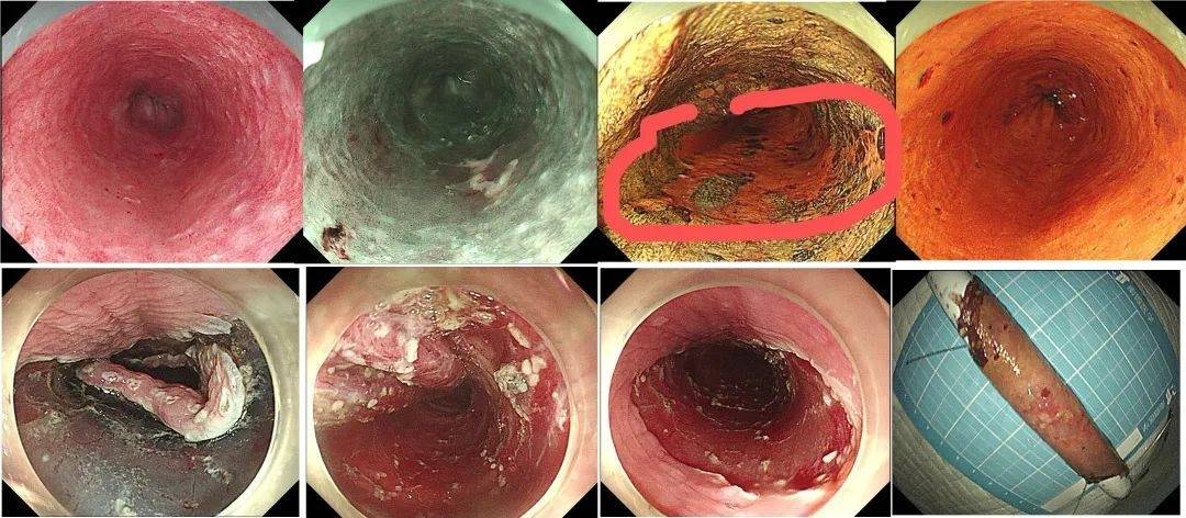 癌,仅仅长在黏膜层,经过徐美东教授这样的巧手,可以把早期的病变在