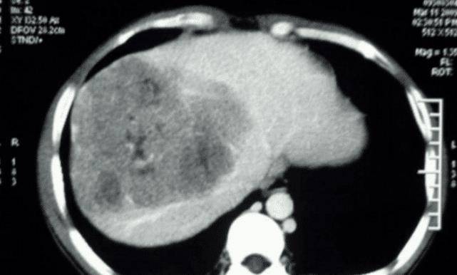 时间|妻子被丈夫一月29次“169”，查出肝癌，医生叹息：都是丈夫害了她