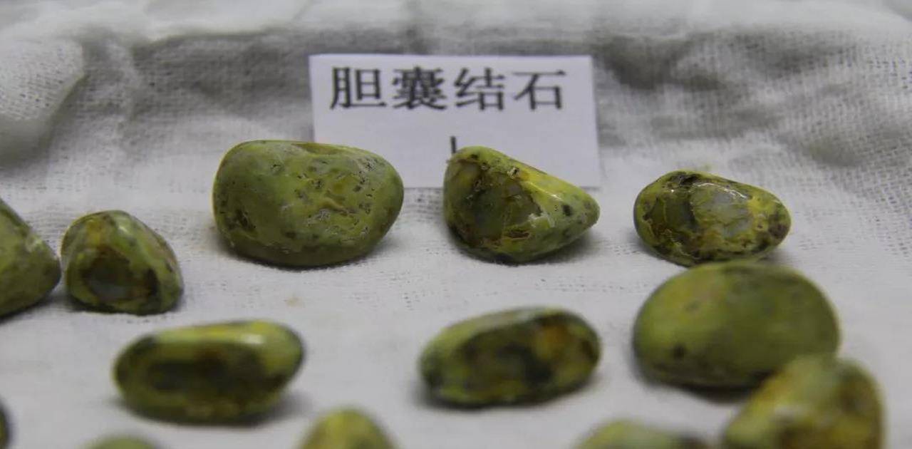 食品|胆结石最“喜欢”4种人，每一种都很常见，但愿你不在其列