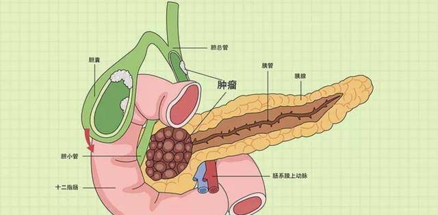 食品|胆结石最“喜欢”4种人，每一种都很常见，但愿你不在其列