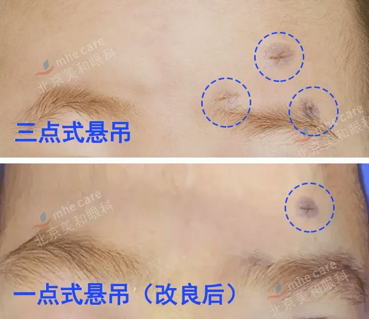 手术|五年八部曲，上睑下垂分阶段治疗的故事